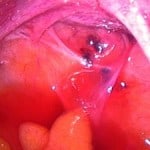 Endometriose-wenn rätselhafte Schmerzen quälen